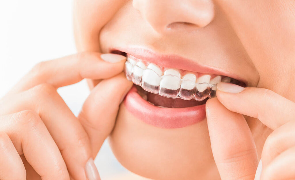 Orthodontics - Smile Gallery